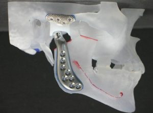 tmj-total-joint-pic
